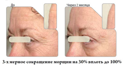 matrixyl 3000 что это